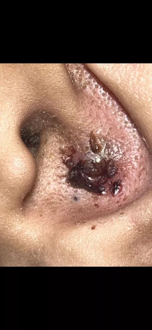 REPOST. Had cyst in ear popped 1 week later. 
