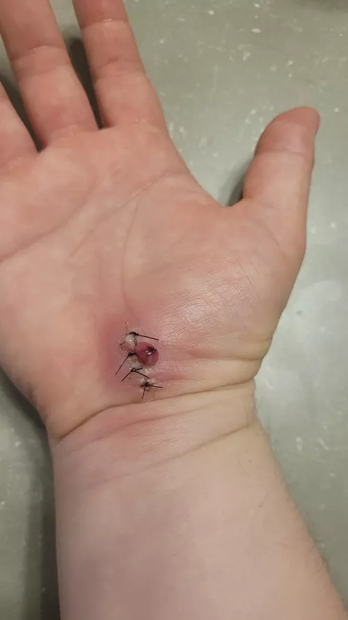 Carpal tunnel release incision got infected the day before my follow-up and suture removal. Managed to release some pressure. Cleaned up and surgeon contacted for antibiotics. NSFW due to bloody discharge and sutures/incision.