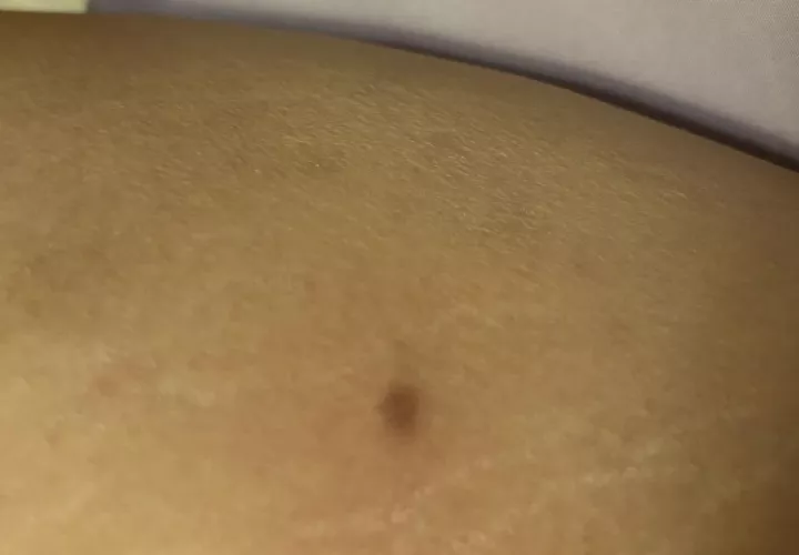 Is this an ingrown hair? A bump but doesn't hurt when touched