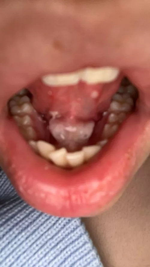 look who came back😃 why are my salivary stones always massive