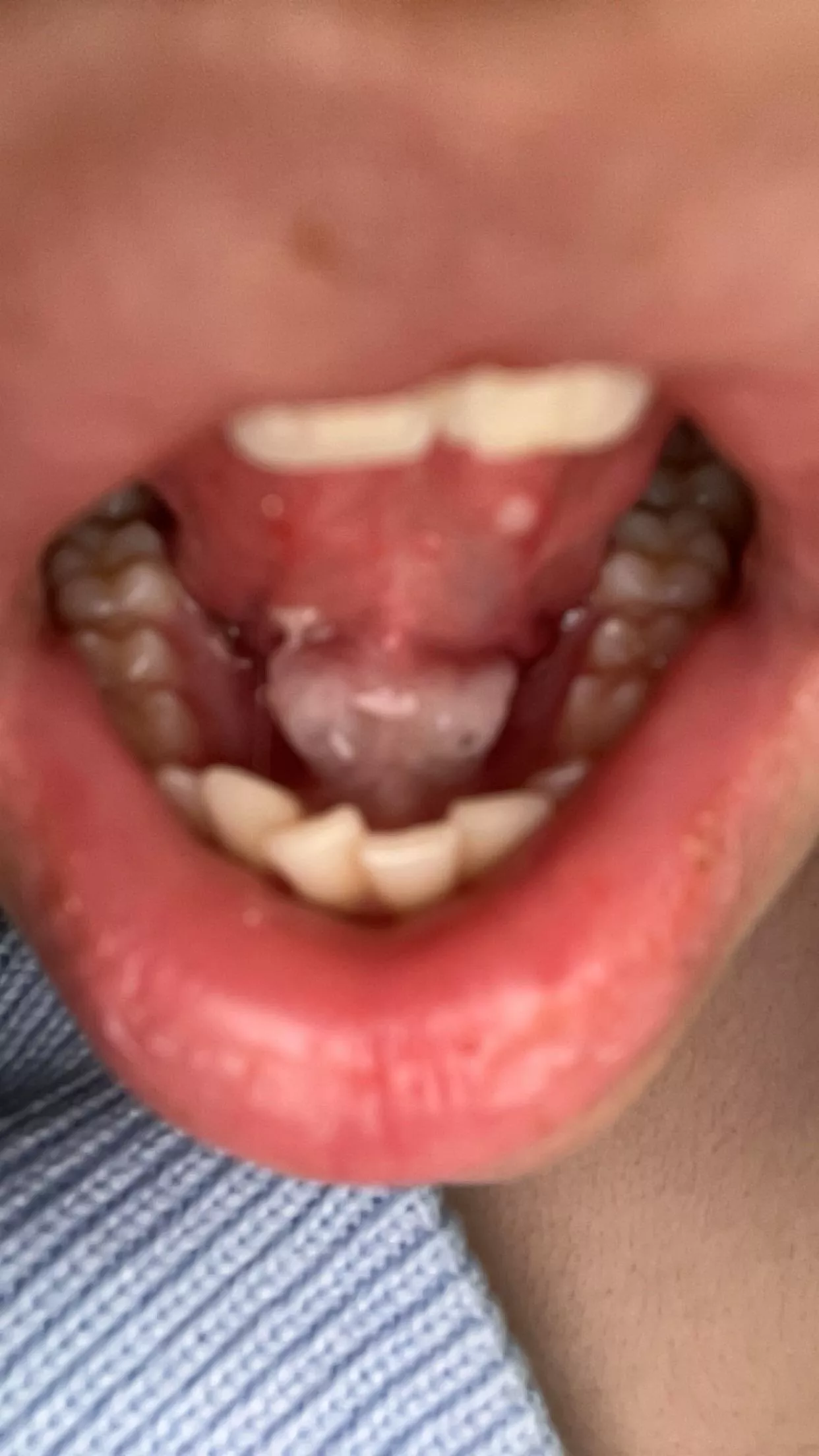 look who came back😃 why are my salivary stones always massive