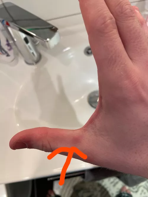 weird bump on my thumb