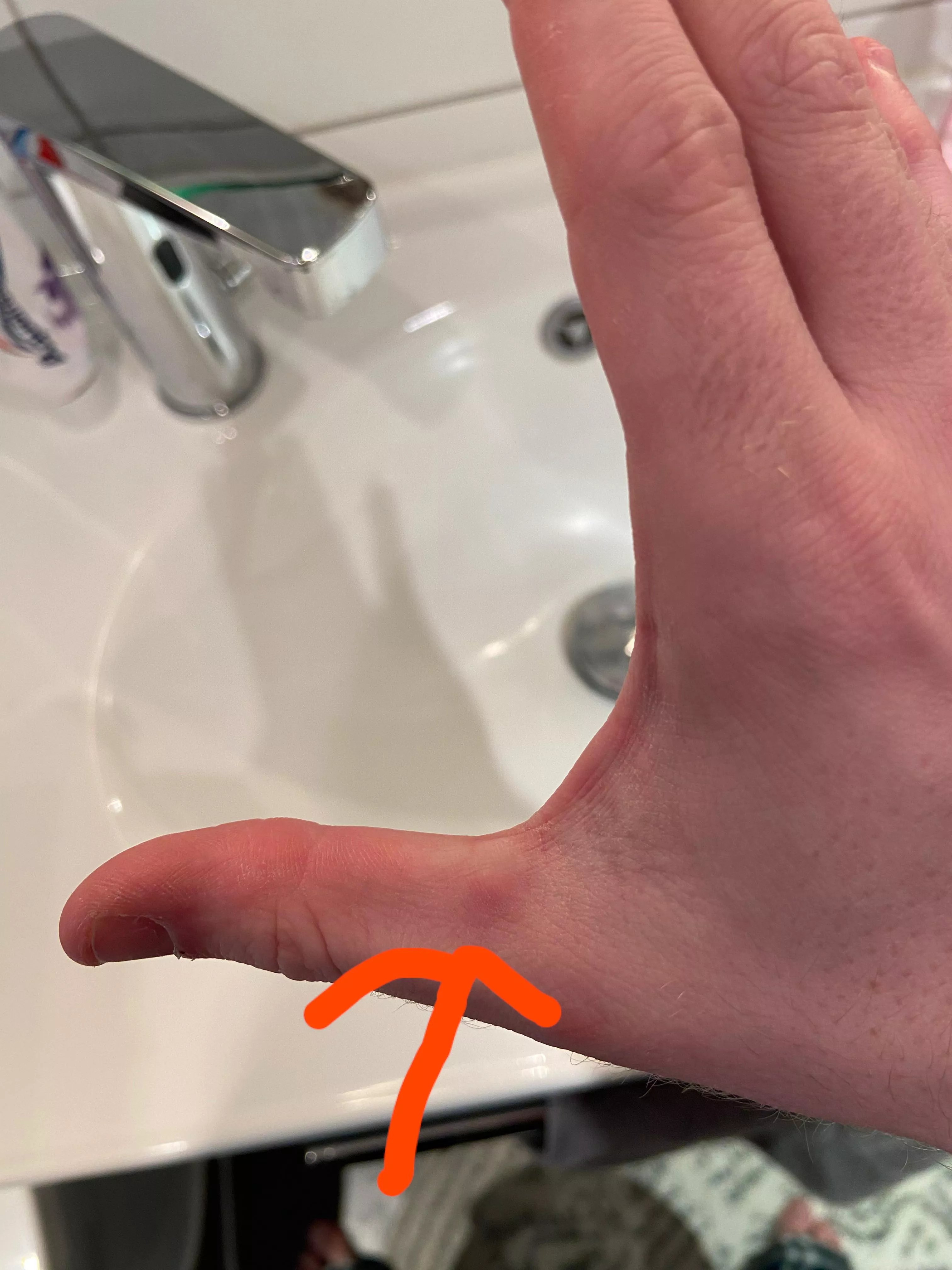 weird bump on my thumb