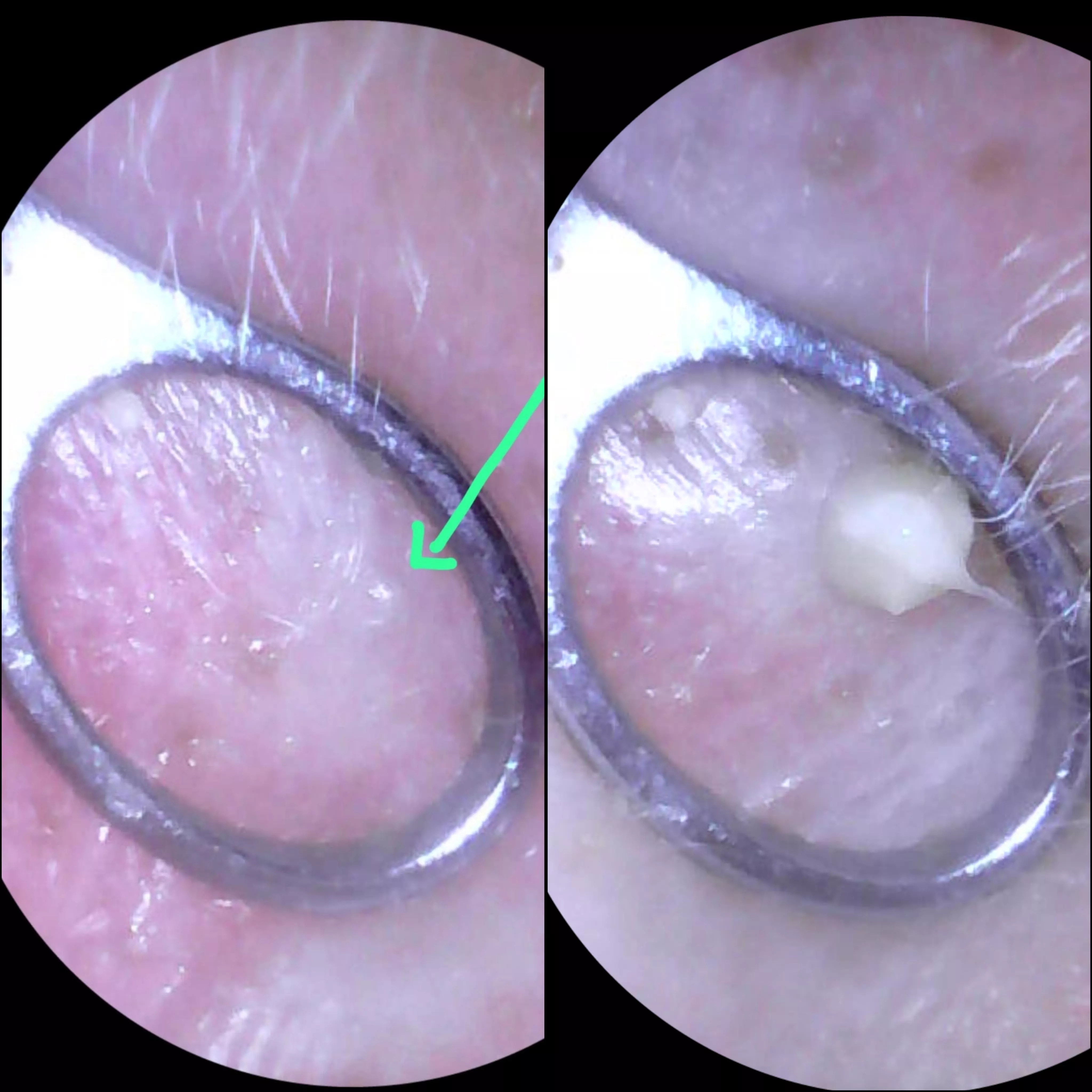 Accidently pressed capture rather than record. Which sucks. But very painful ear, was only a tiny bump but went pop!