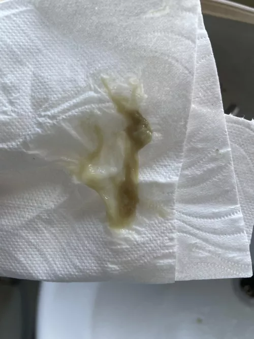 This practically crawled out my nose after a 3 month sinus infection 