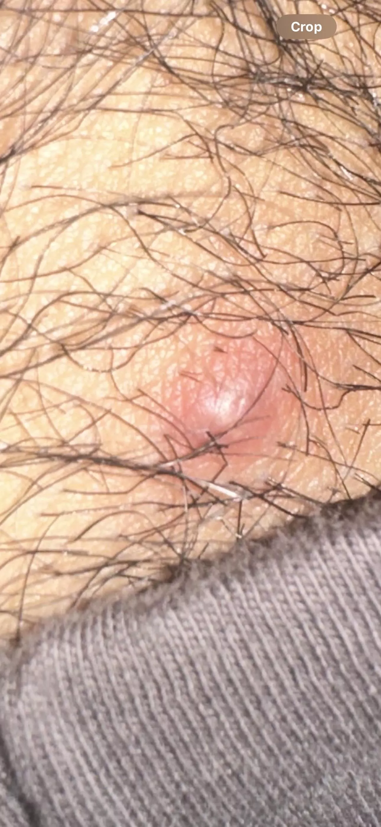 is this infected? Tried popping it yesterday to no avail and now I have a 100f fever