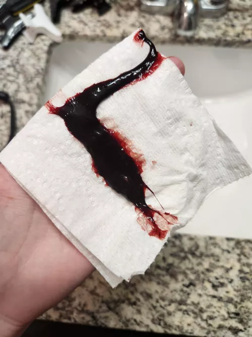 One week post op bloodclot from sinus surgery