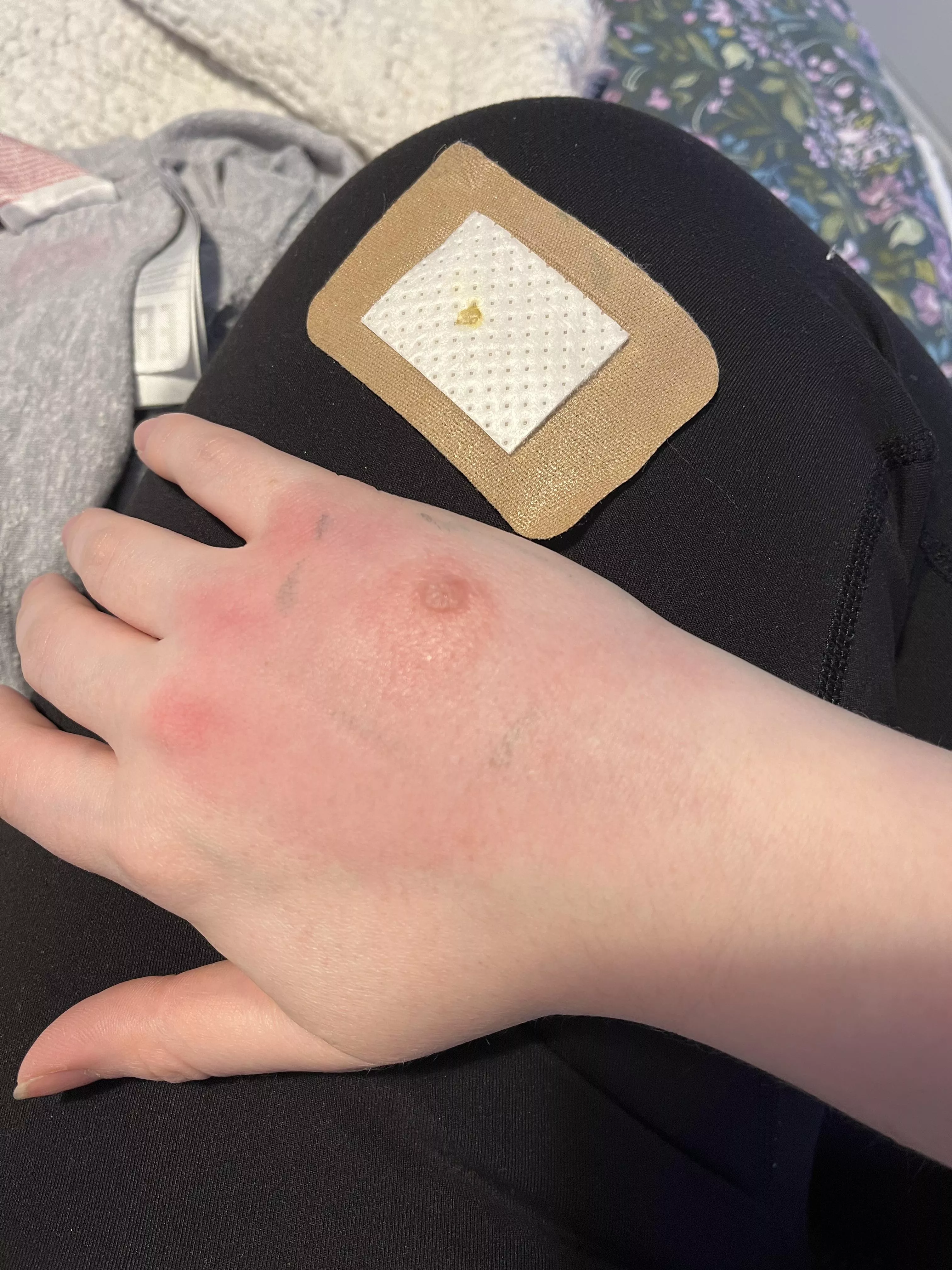 update - insect bite blister aged like milk within about 9hrs 