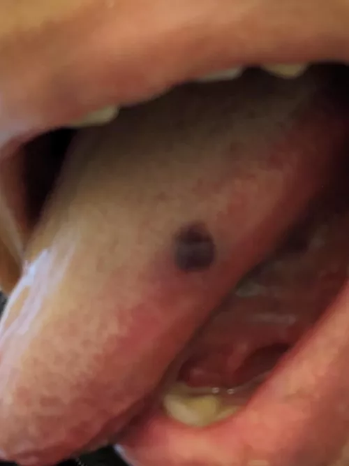 I know when spring is in the air since these little blisters with blood or clear fluid start happening in my cheeks. If I use my fingers to try to pop, they often expand instead of popping. This is the first time in the 20 or so years I've been getting 