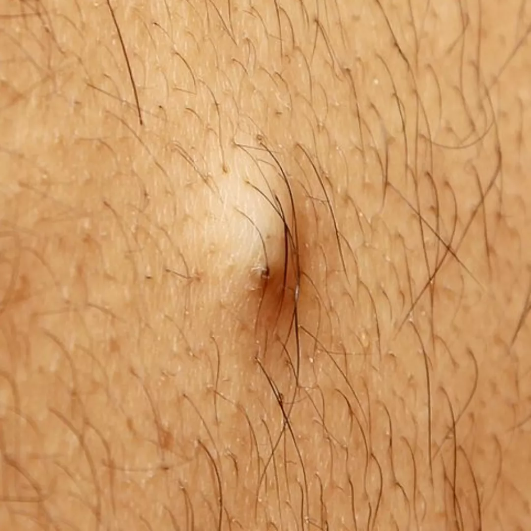 Maybe long shot, but looking for my popping white whale from this sub (?): video, dozens of raised white bumps under skin (see pic for similar) on face, out came only small-medium sized white hard nodules, slight scraping sounds while extracting (tool on