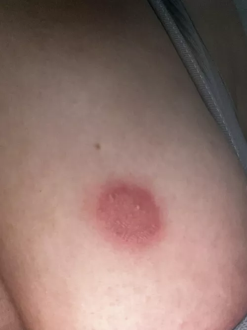 Pustules/ringworm. Forbidden pop!