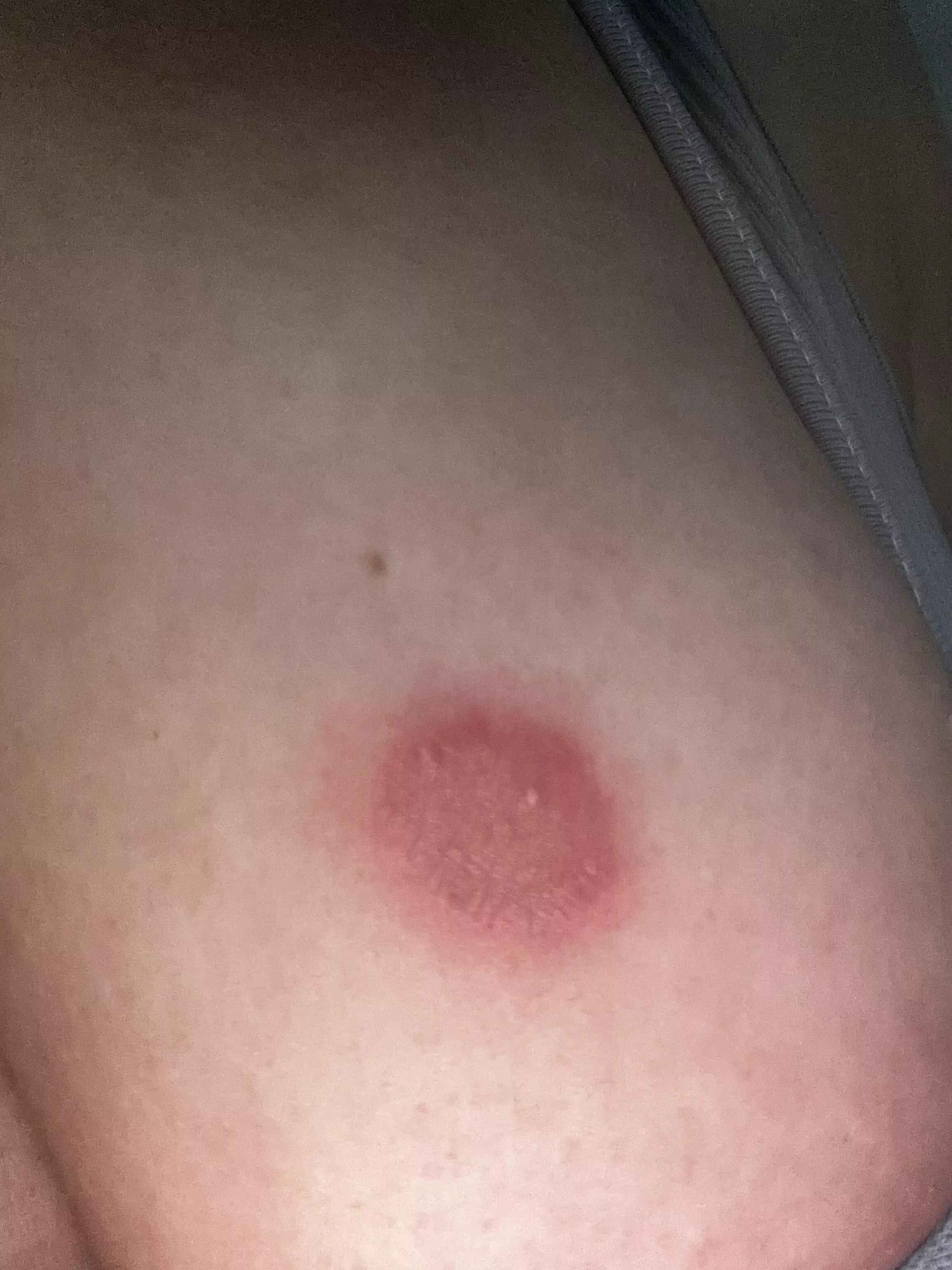 Pustules/ringworm. Forbidden pop!