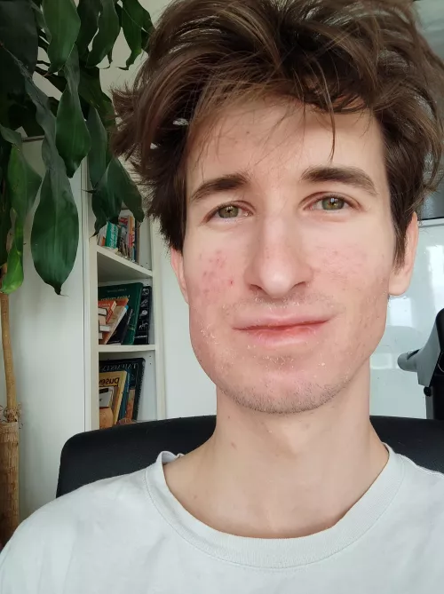 After wisdom tooth extraction 🥲