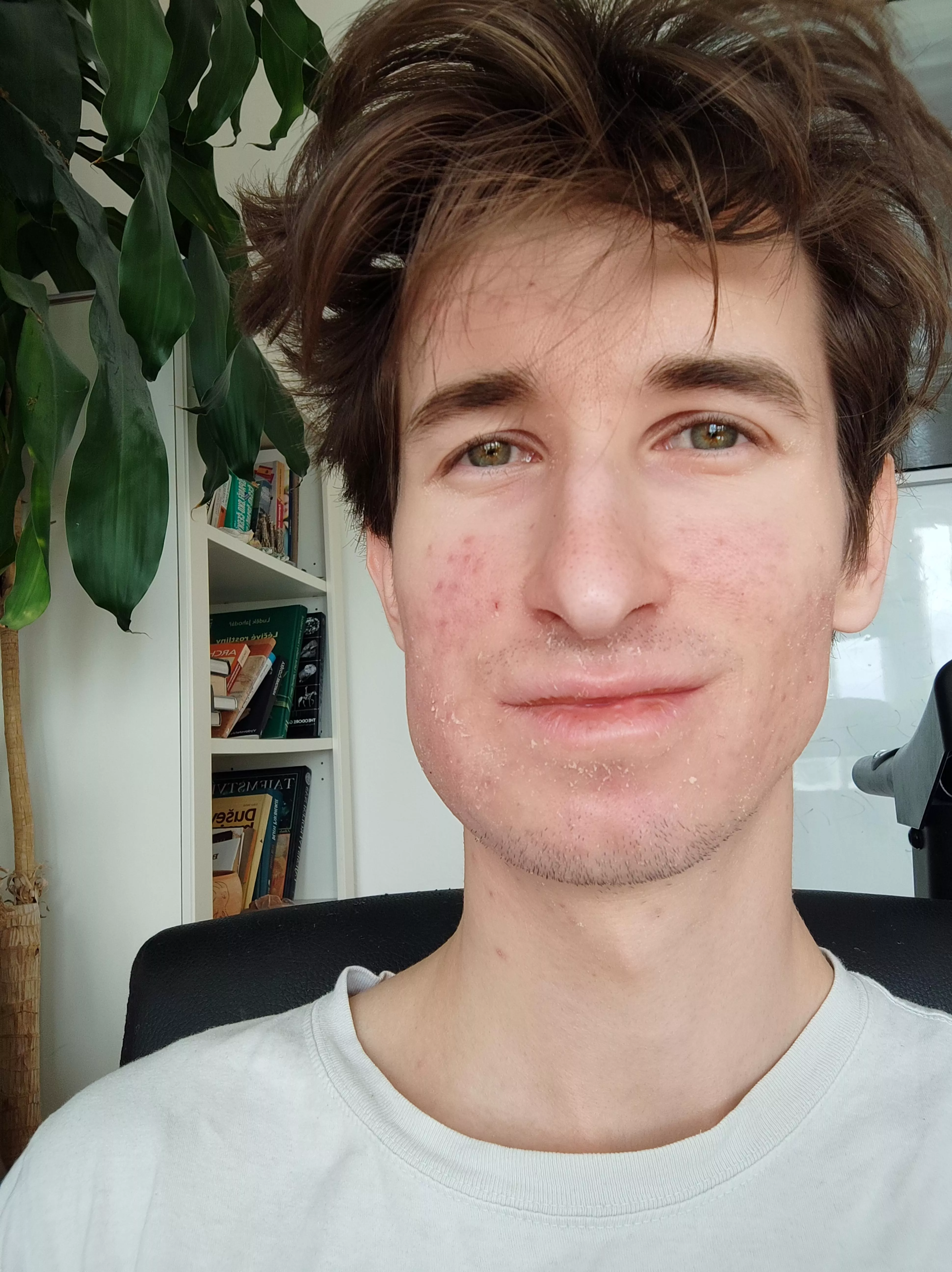 After wisdom tooth extraction 🥲