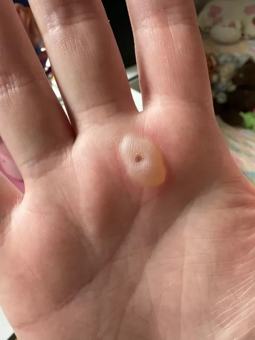 Forbidden Palm Blister