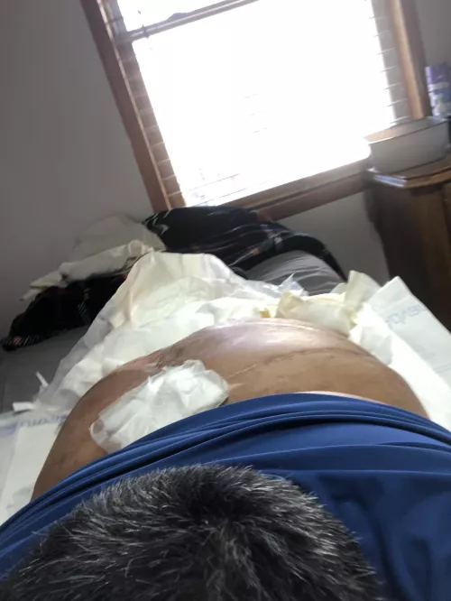 Gay superchub bottom. I am in a wheelchair and paralyzed from the waist down if still interested hmu. Sorry about the bandage in the pic.