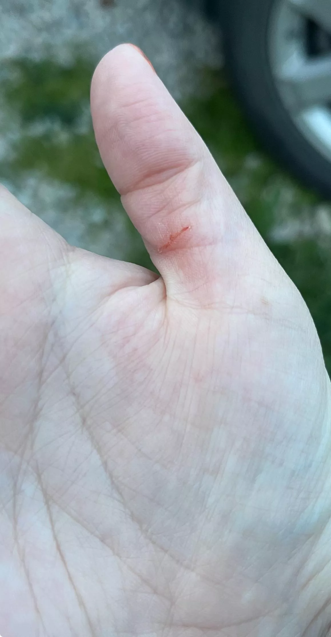 I thought maybe I could handle removing at least some of my cyst. I was wrong. It’s deeper than the picture shows but not deep enough to warrant stitches and I feel a little queasy from the pain in the soft tissue🙃