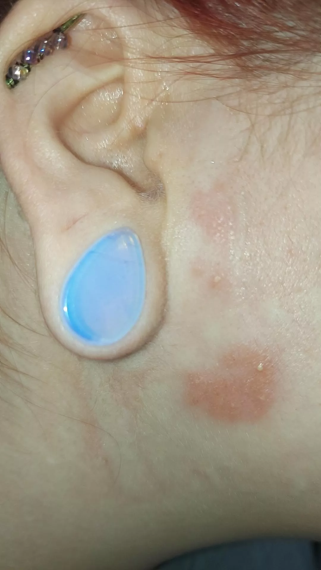 My shingles forbidden pop.