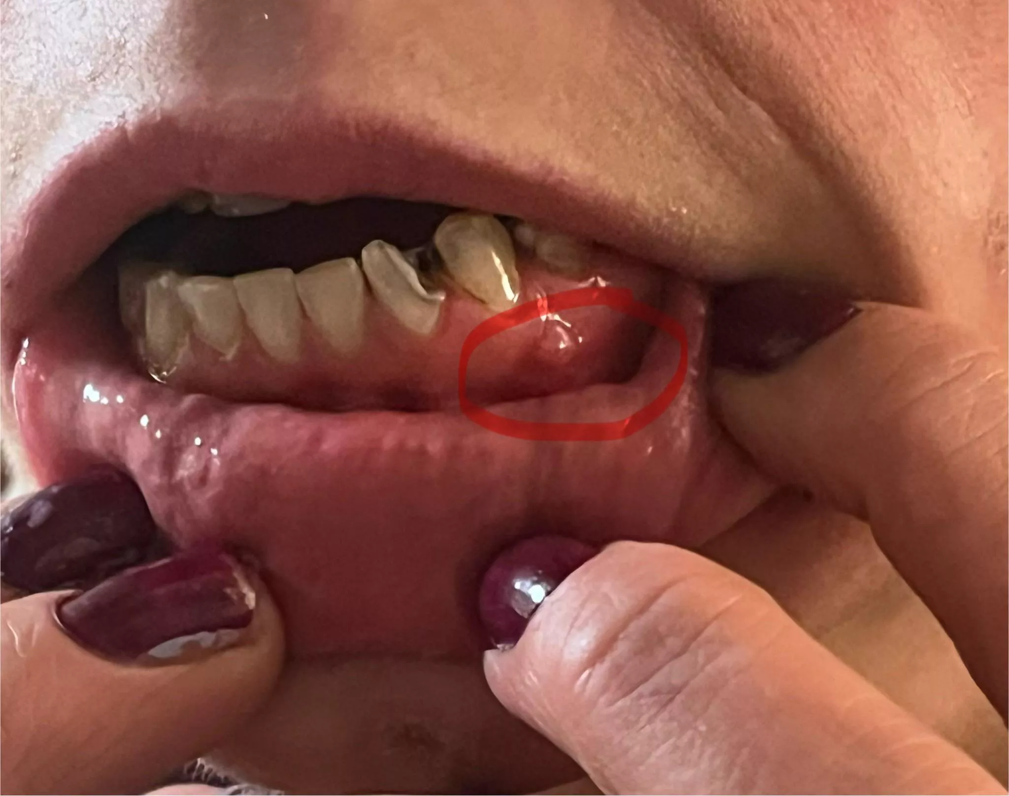 Small abscess - how serious?