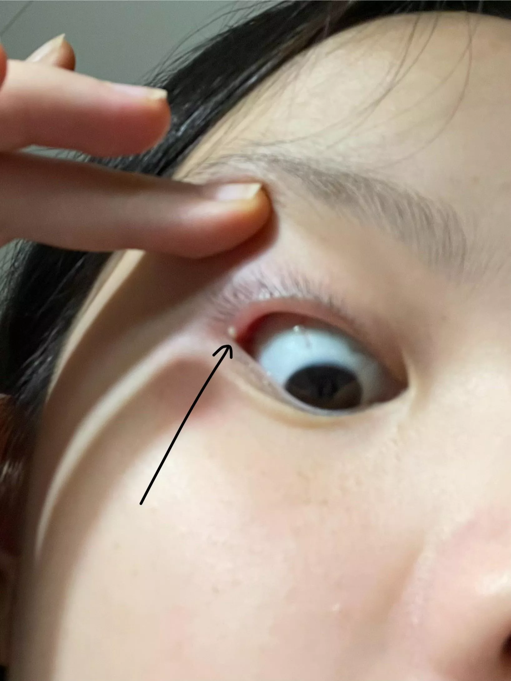 What is this white dot on my eyelid and what should I do about it?