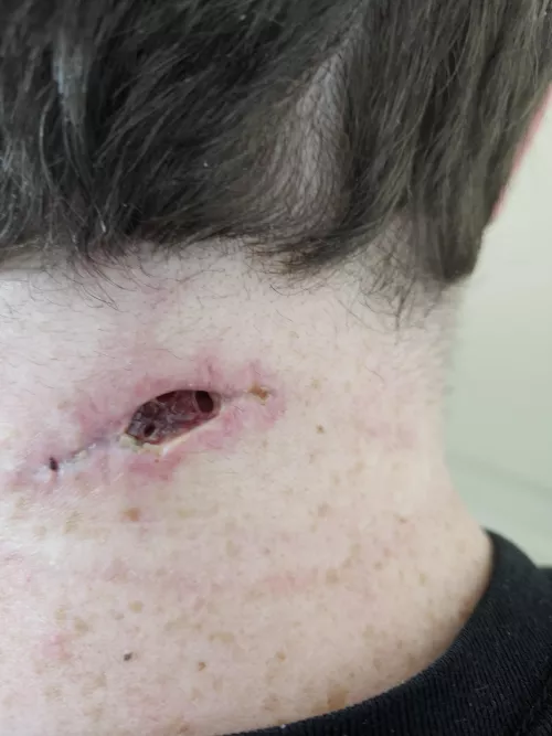 Had a growth removed from my neck almost 6 years to the day an identical growth was removed...