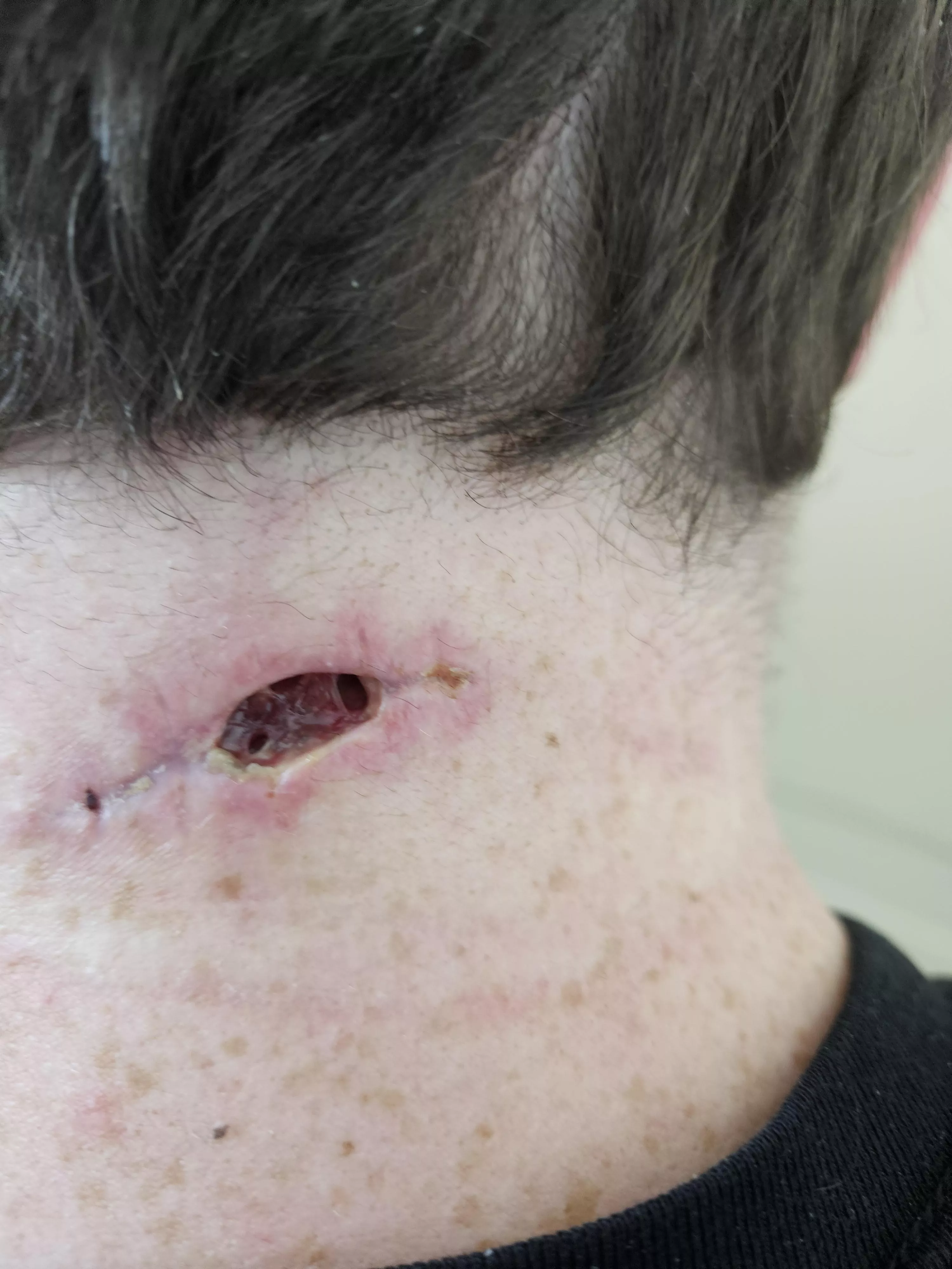 Had a growth removed from my neck almost 6 years to the day an identical growth was removed...