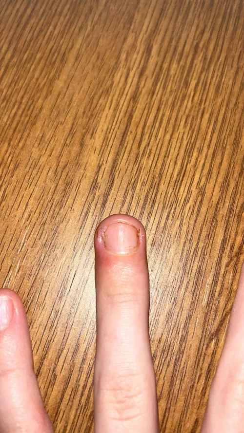 ingrown fingernail hurts so bad.