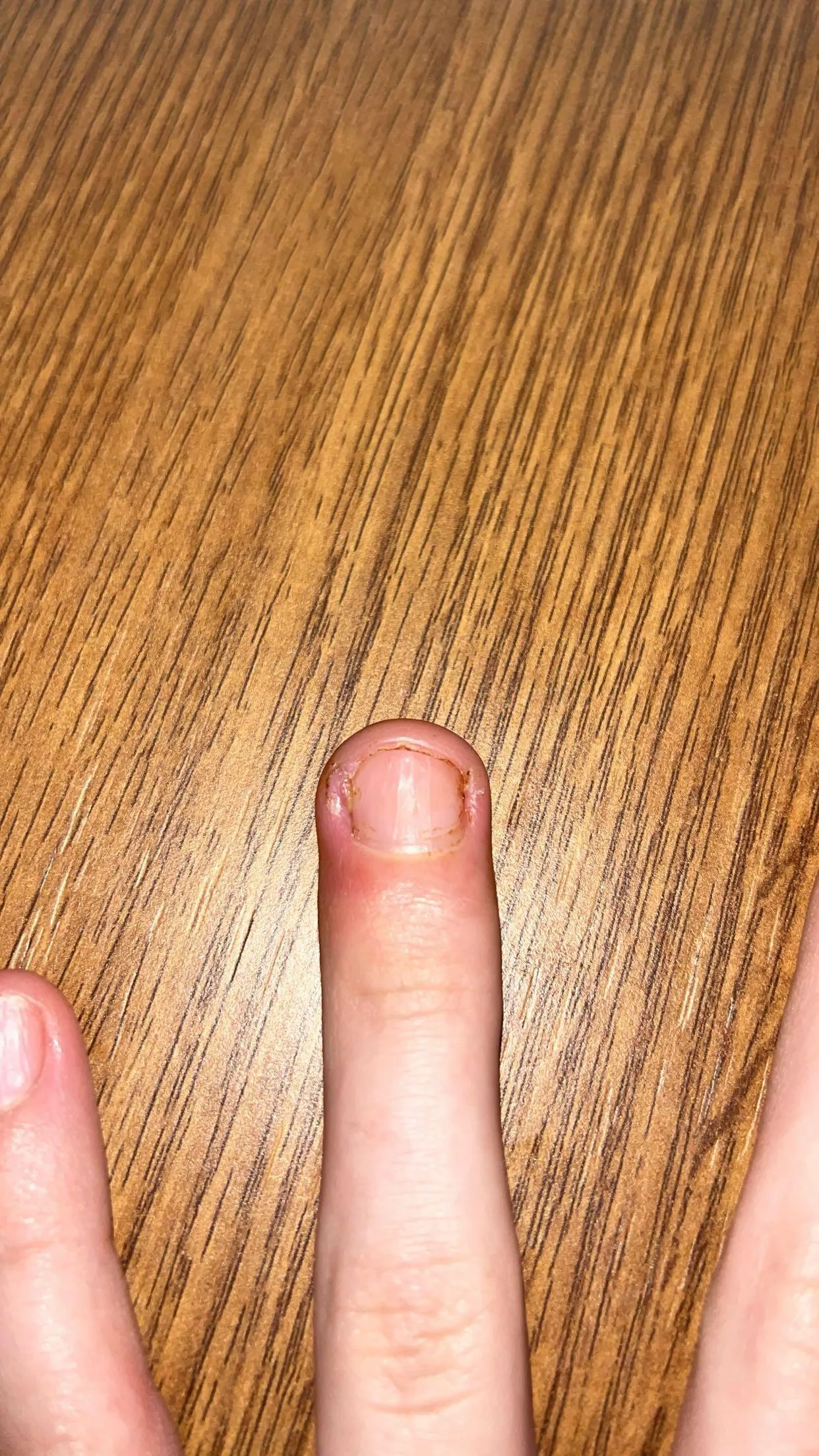 ingrown fingernail hurts so bad.