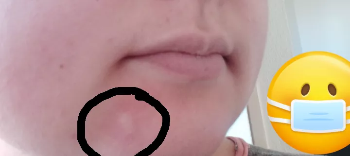 Tried popping, but it doesn't want to yet. Leaking some fluid tho