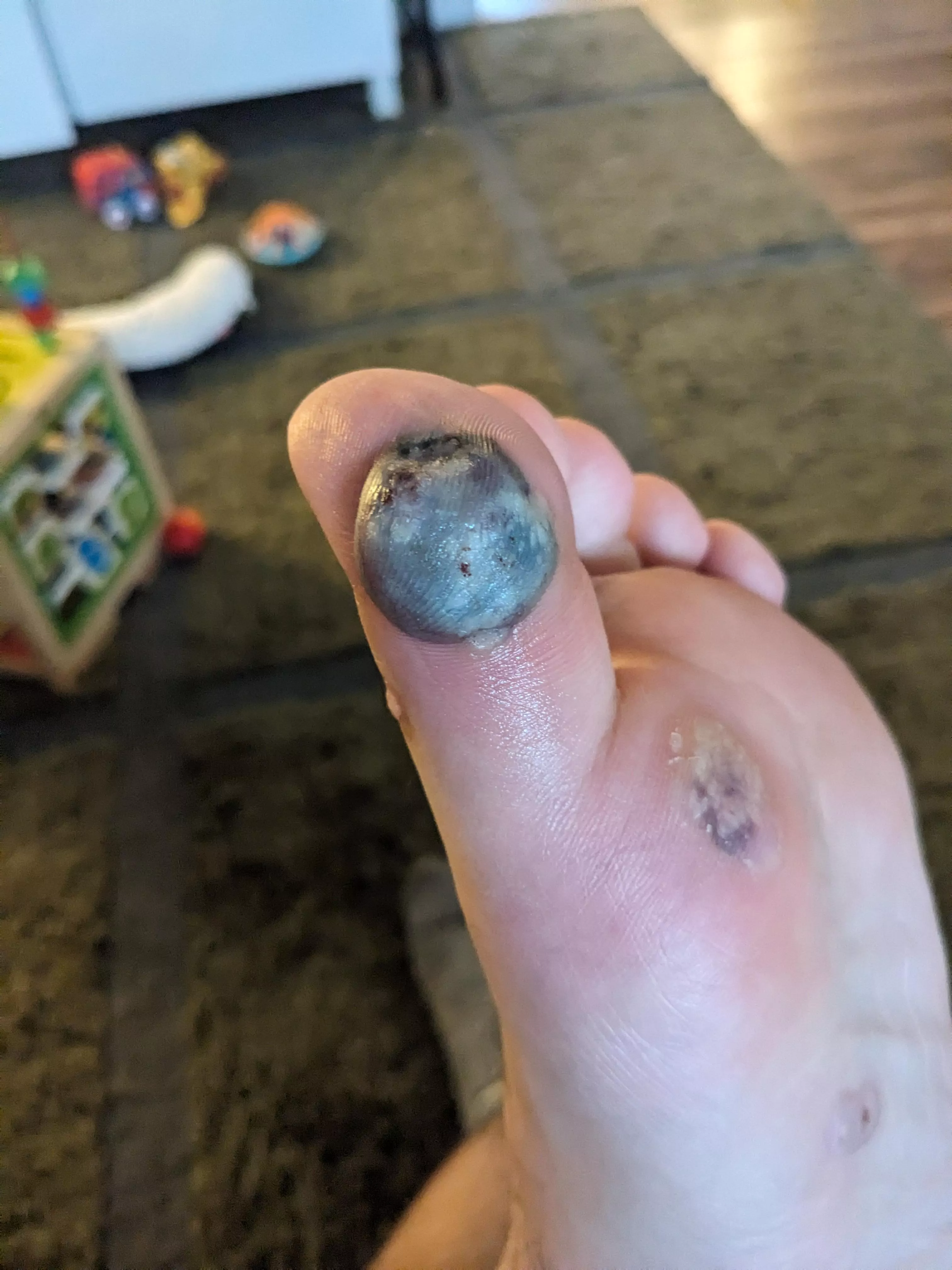 Wart freezing blood blister popping time.