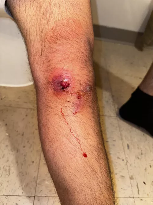 Low grade fevers and painful swelling