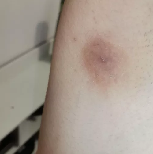 Aftermath of removing a boil on my armpit