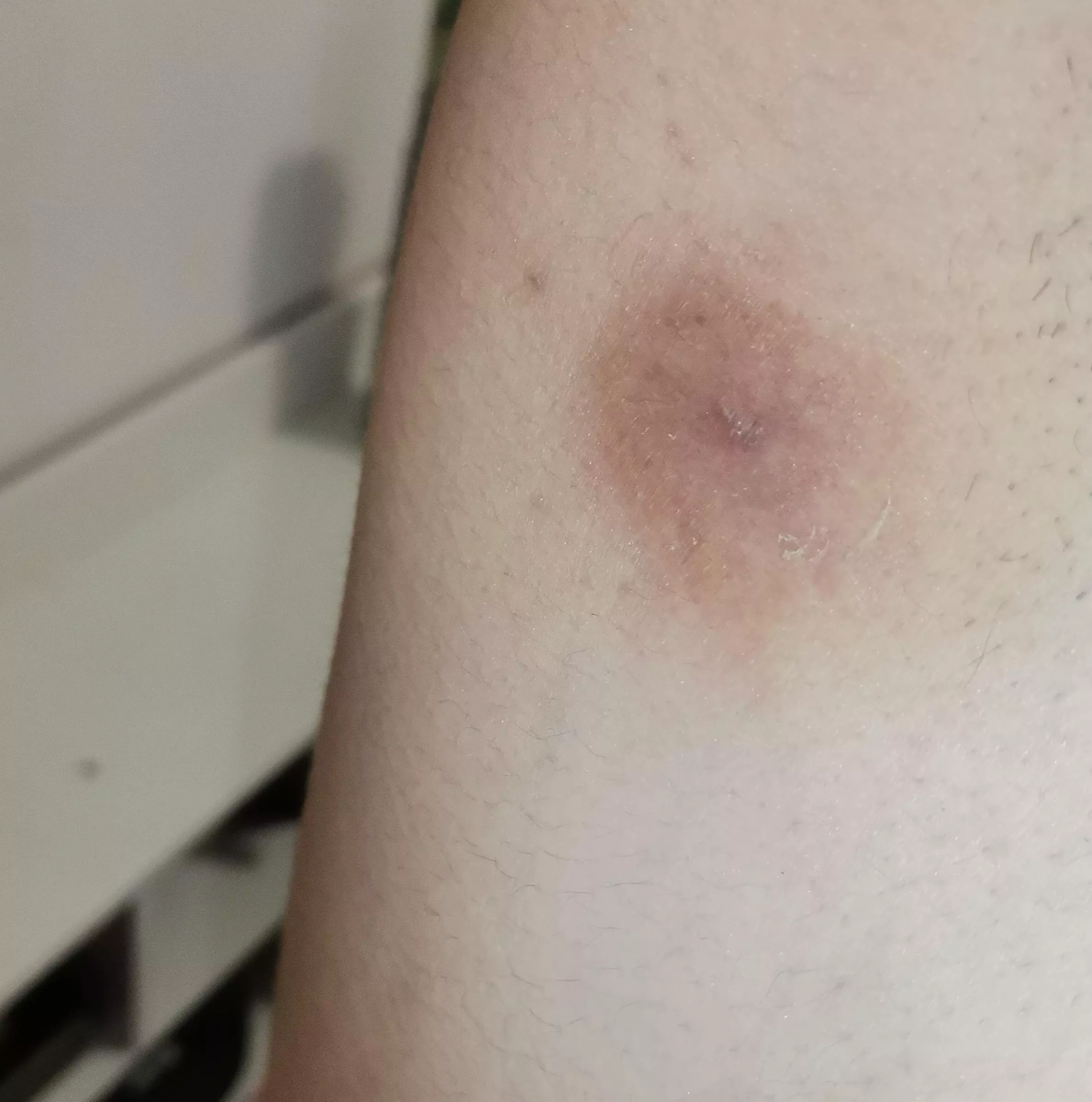Aftermath of removing a boil on my armpit
