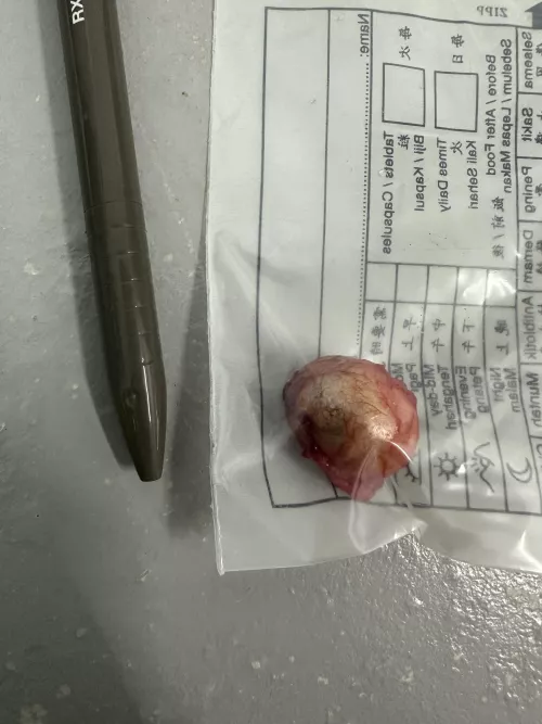 Sebaceous Cyst (Pen for scale)
