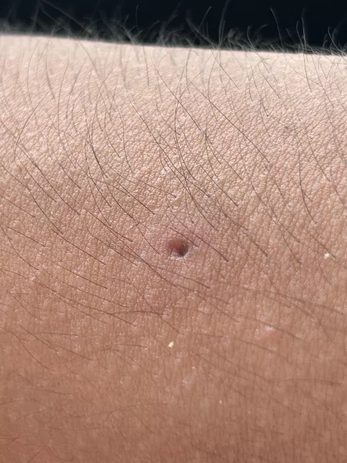 Update: juicy arm cyst