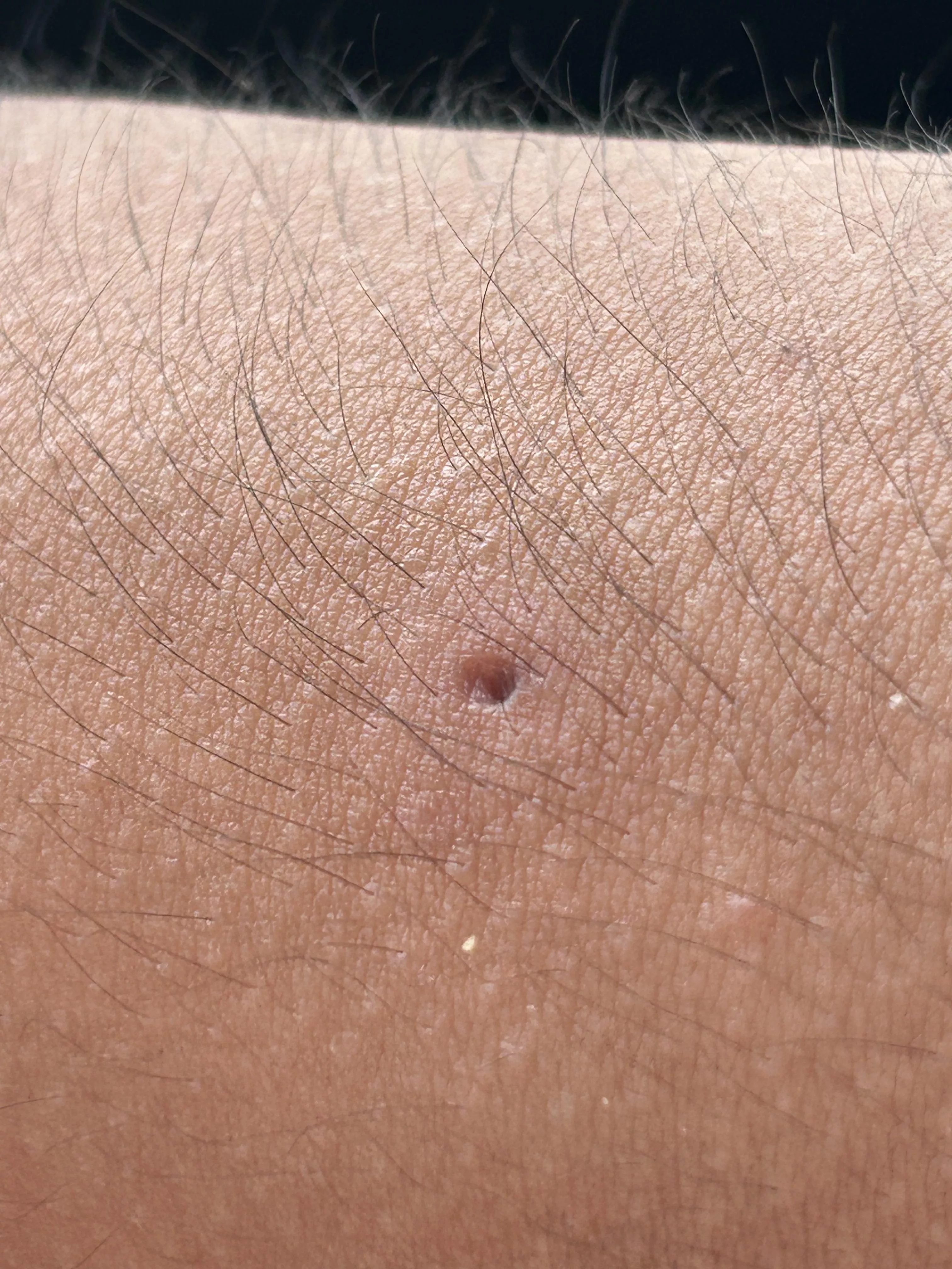 Update: juicy arm cyst