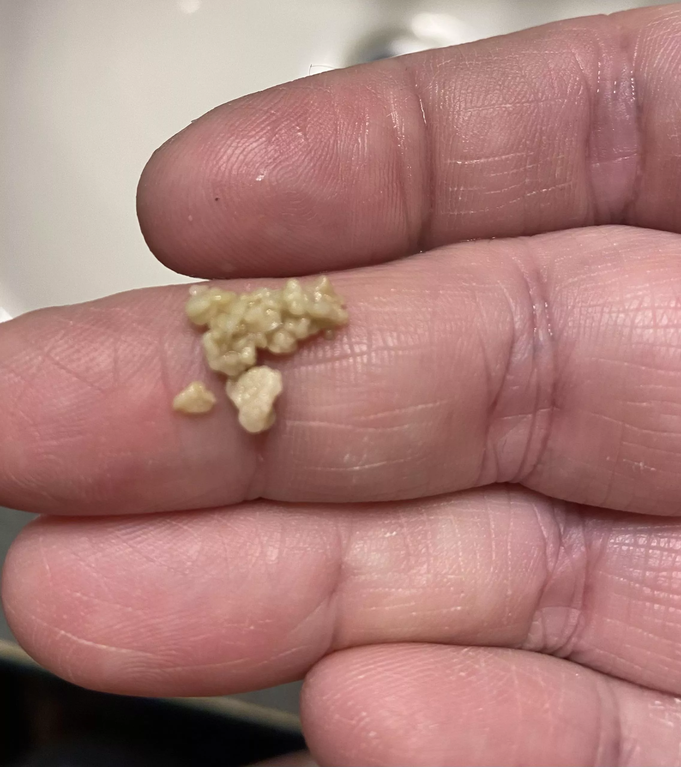 Tonsil Stones that I have to remove every month- only started having these after having Covid