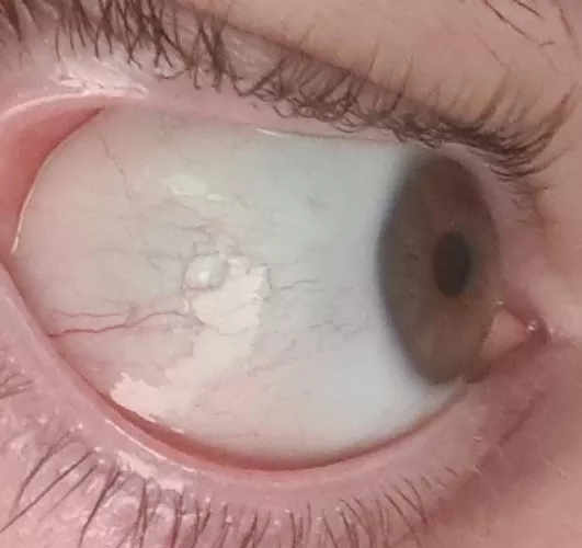 Eyeball bubble after hayfever