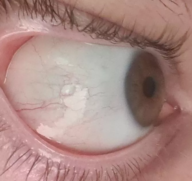 Eyeball bubble after hayfever