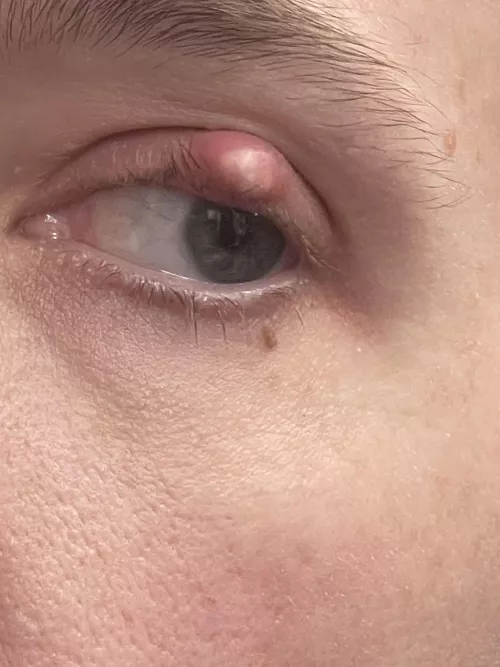 Forbidden pop on my eyelid