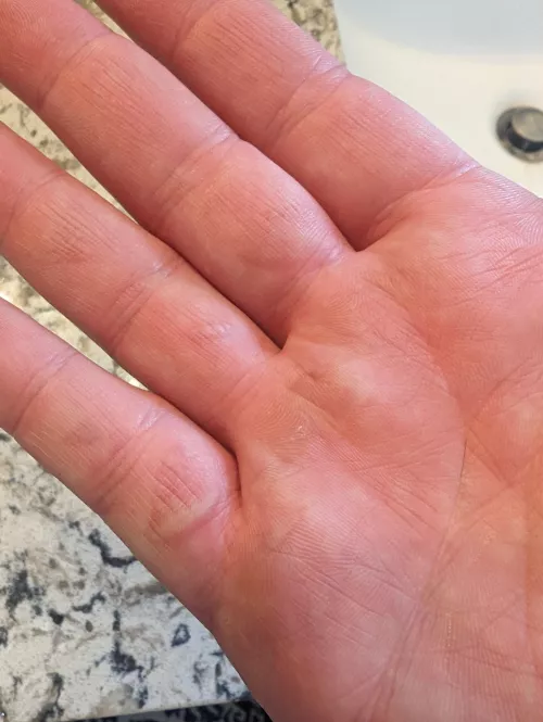 Like an absolute dumbass, I grabbed hot steel while forging with my bare hand