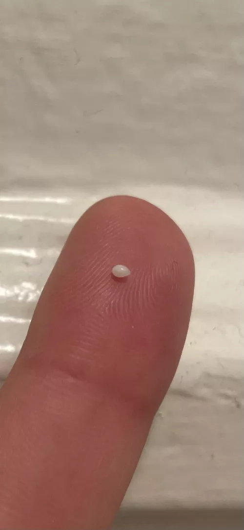 Little pearl emerged from a spot on my leg where I had a small cyst years ago