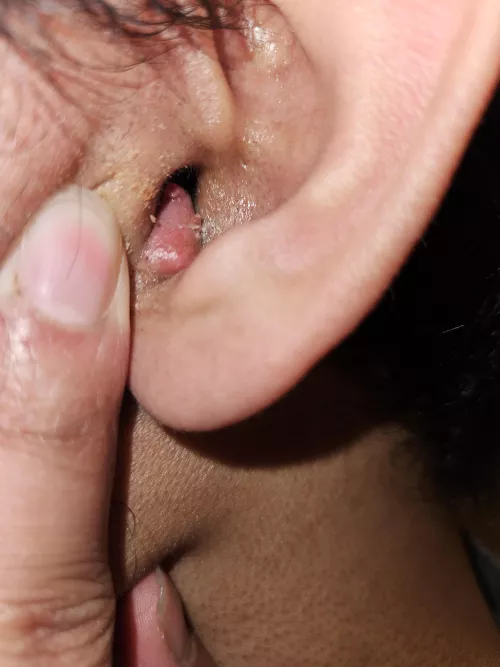 Pimple inside my ear canal