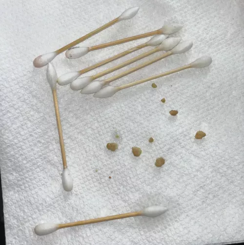 big tonsil stone haul 