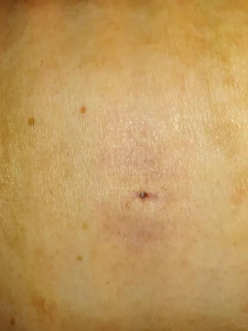 Drained sebaceous cyst hole