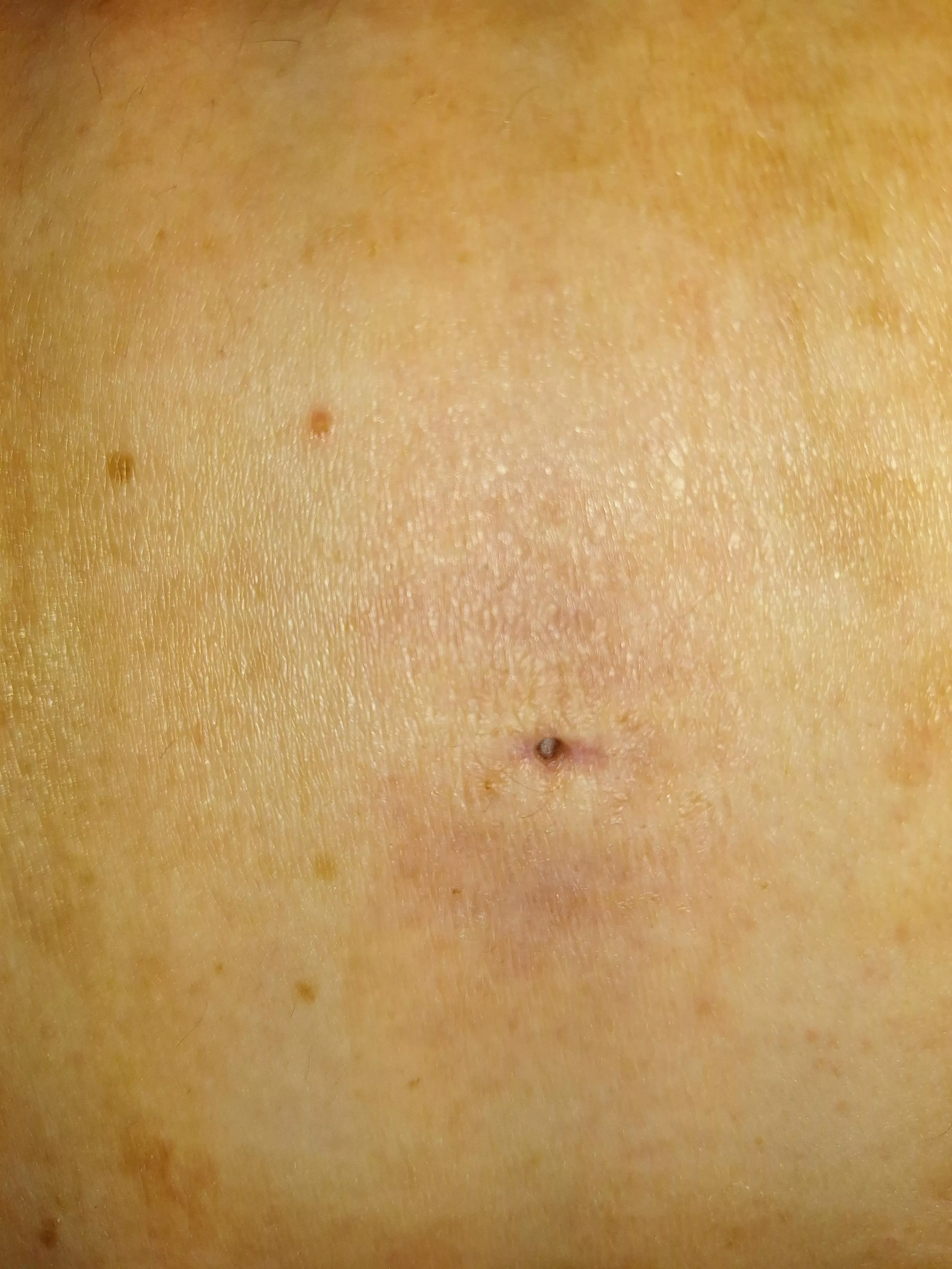 Drained sebaceous cyst hole