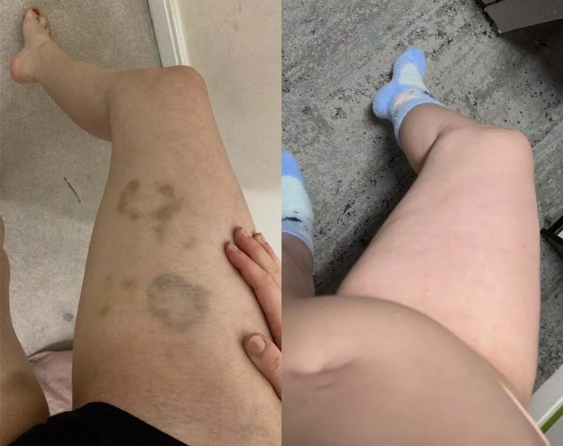 I love how fat my belly and legs have got 😍