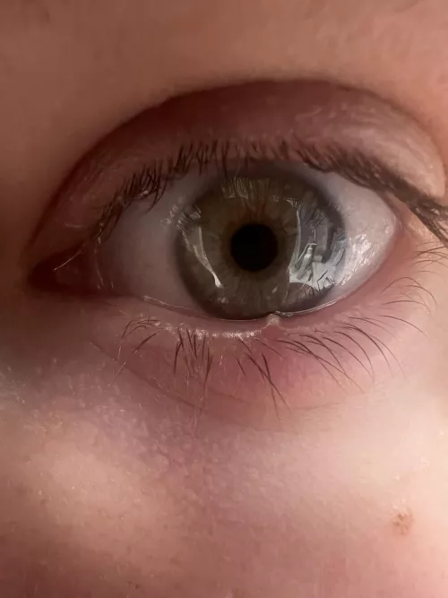 Painful stye lower eyelid