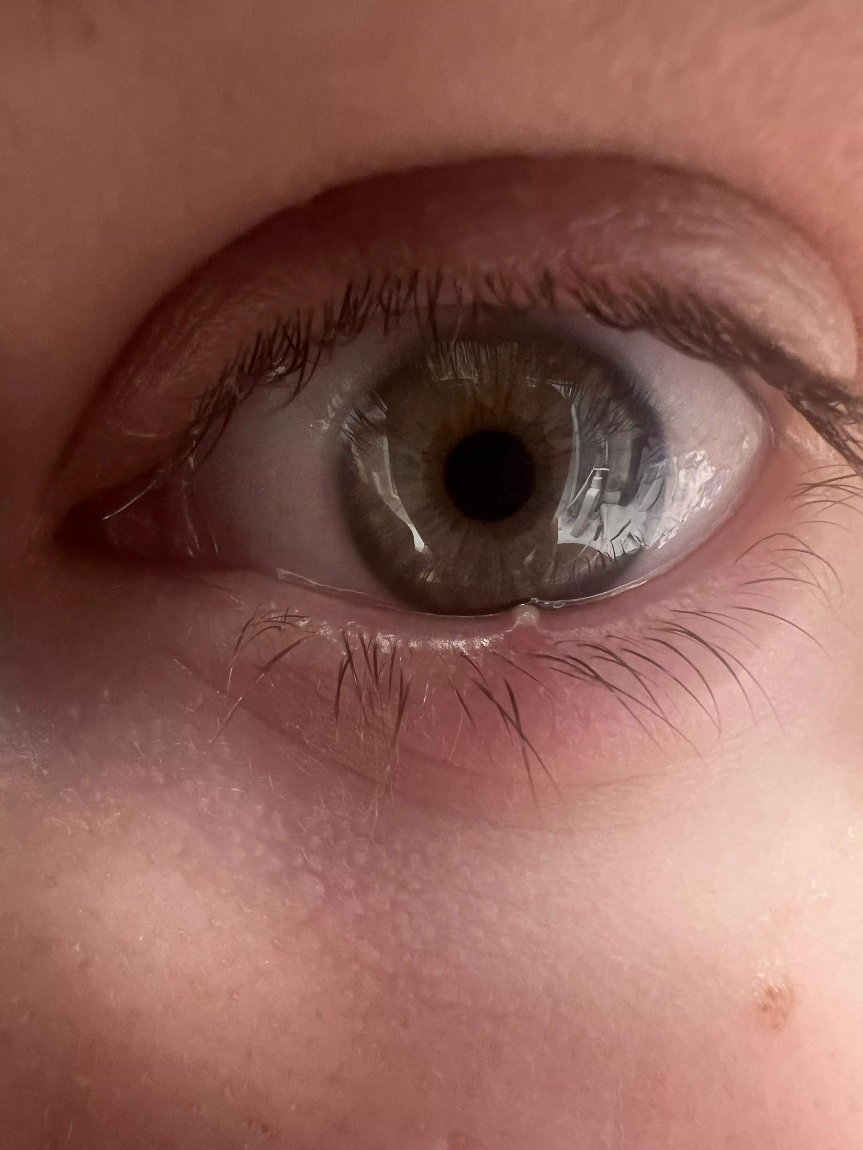 Painful stye lower eyelid