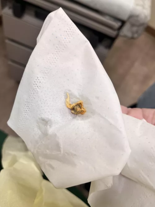 went to dr for ear infection - couldn’t see ear drum because it was blocked by this beast